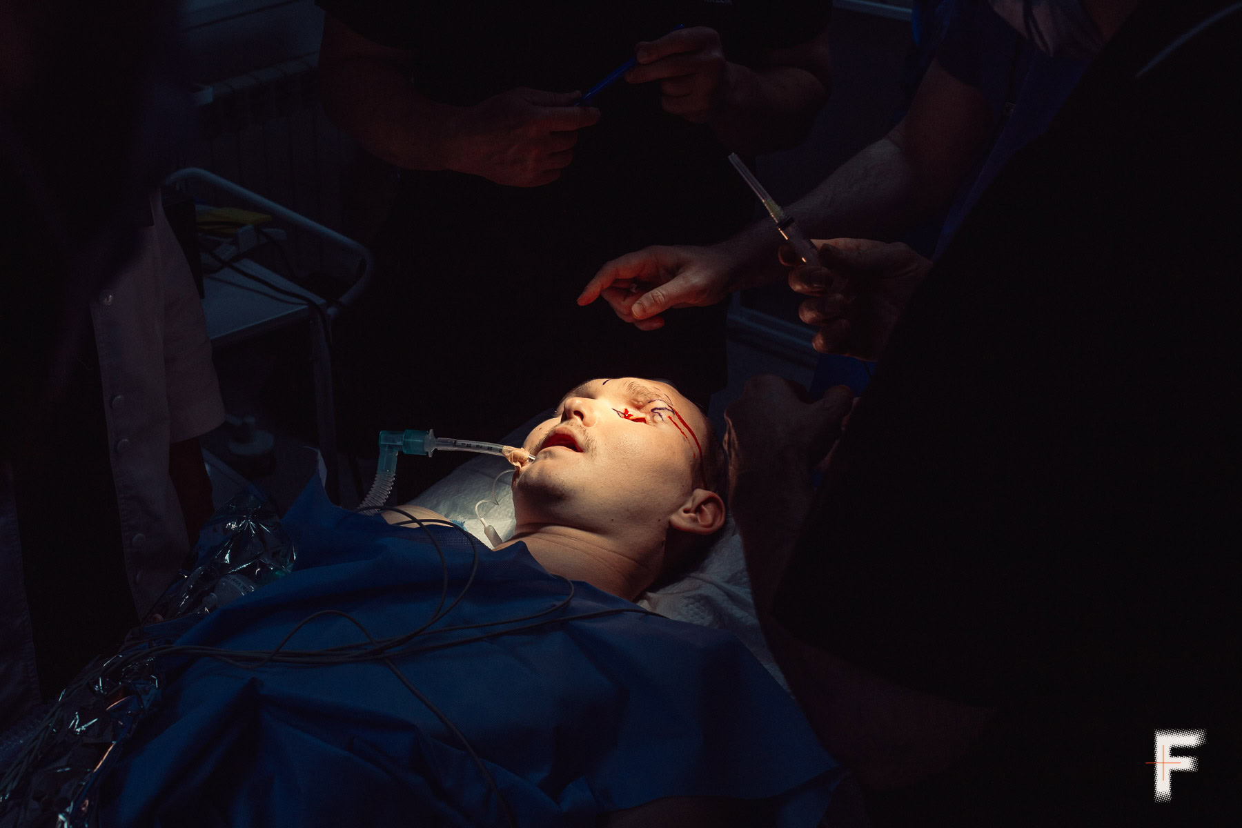 Пацієнт проходить реконструктивну хірургію обличчя в операційній.