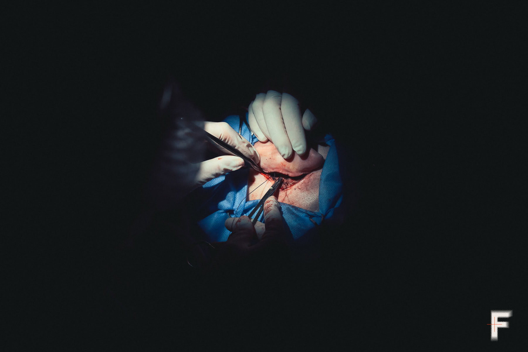 Крупний план вуха під час імплантації слухової тканини.