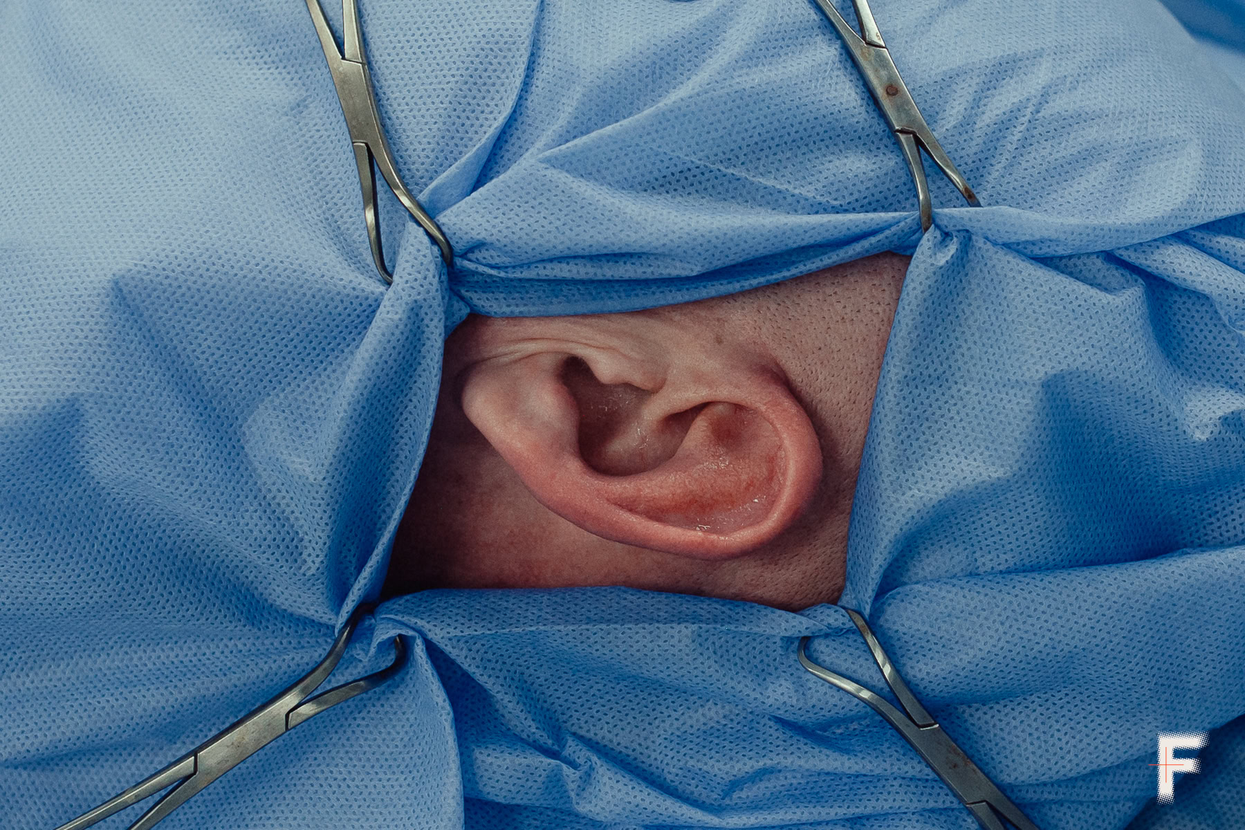 рупний план вуха ветерана під час підготовки до операції.