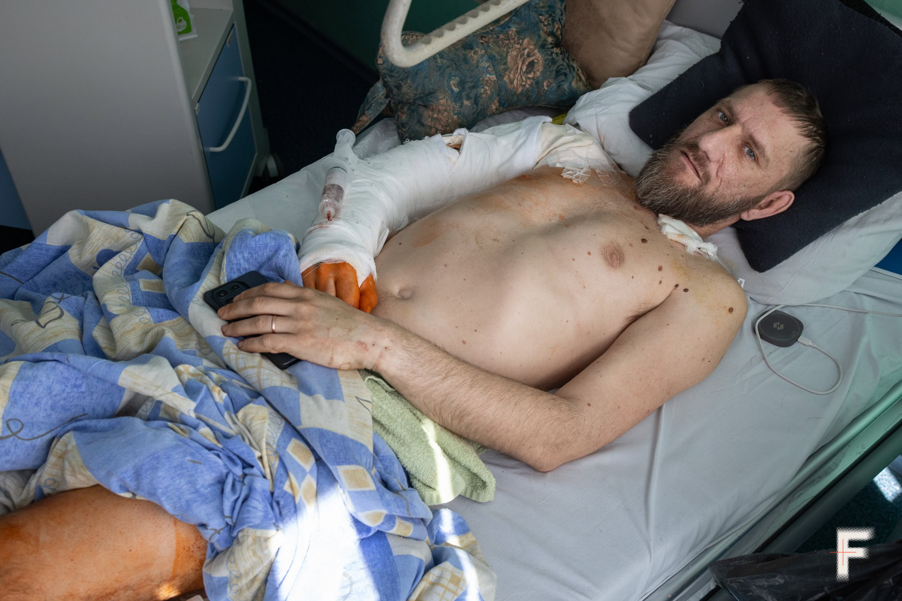 Український військовий у палаті після серії операцій з відновлення важко травмованої руки та ноги.