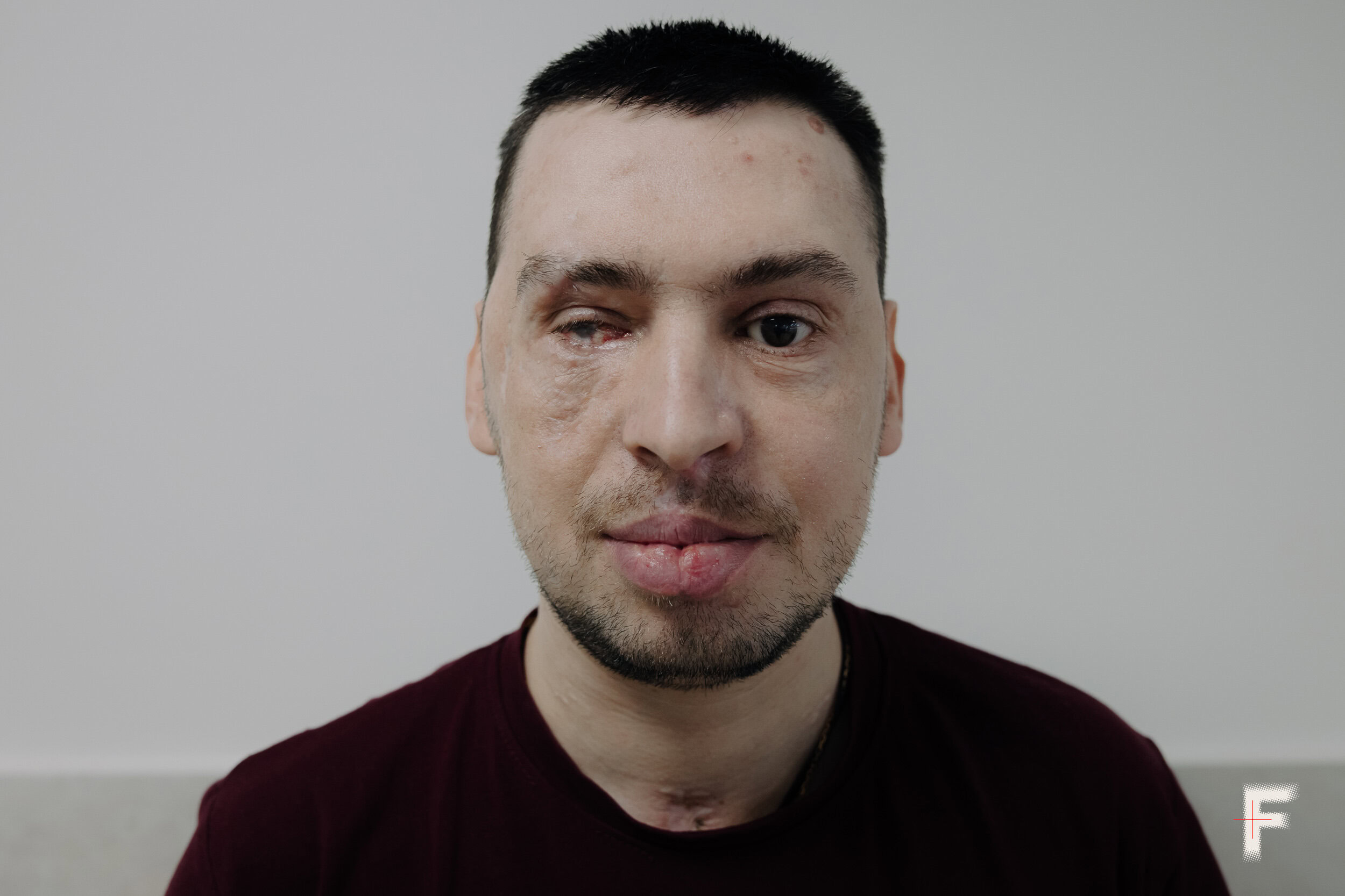 Портрет ветерана Валерія Ніколаєва, який втратив око внаслідок війни, Львів, Україна