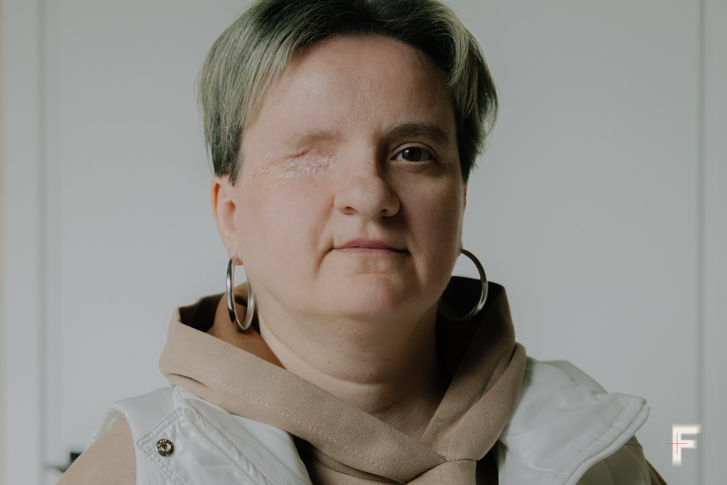 Пацієнтка Вікторія Фролова після втрати ока у Львові, Україна