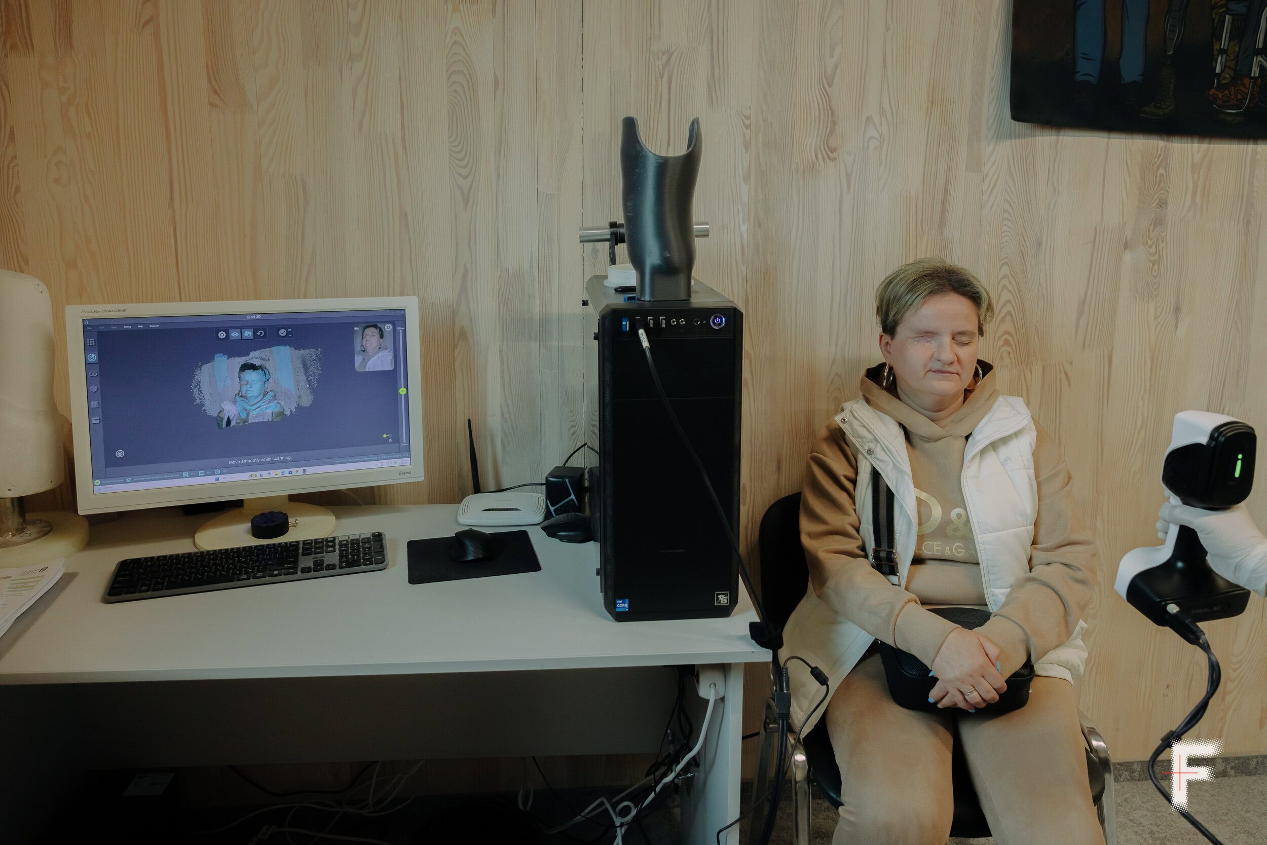 3D-сканування обличчя пацієнтки Вікторії Фролової для створення екзопротеза у Львові, Україна
